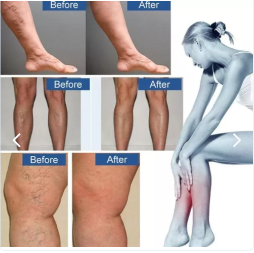 🌿 Parche Natural para Várices – Circulación Activa y Piel Saludable